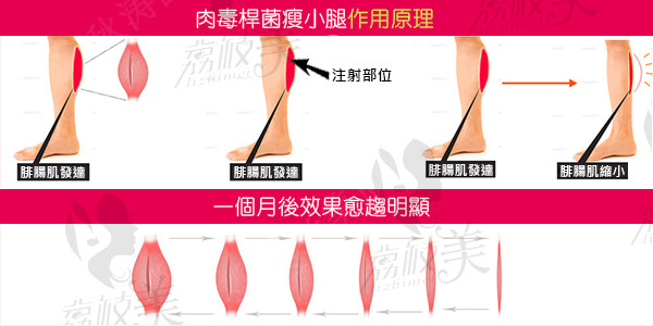 瘦腿针原理示意图