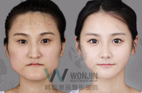 韩国原辰整形脸型对比案例
