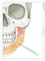 下巴抽脂示意图