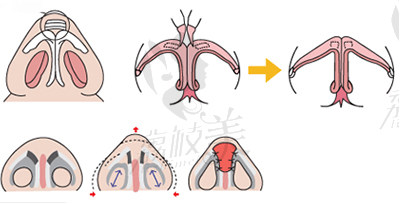 隆鼻手术过程