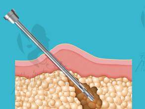 吸脂示意图