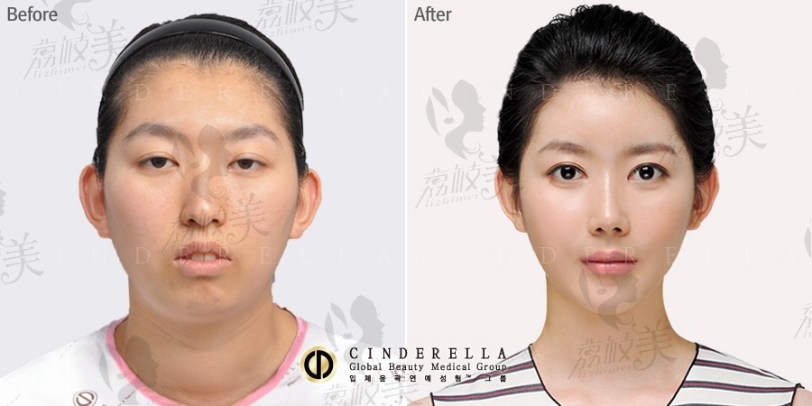 韩国新帝瑞娜眼部手术对比图