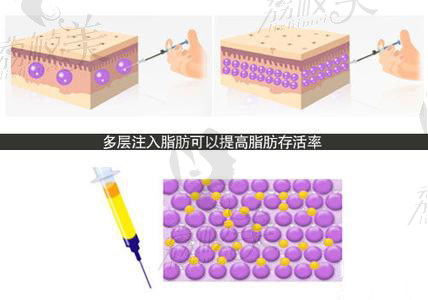 自体脂肪移植技术示意图