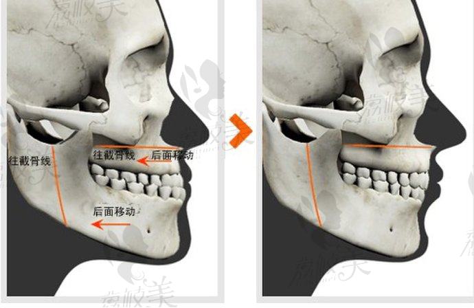 双鄂手术示意图