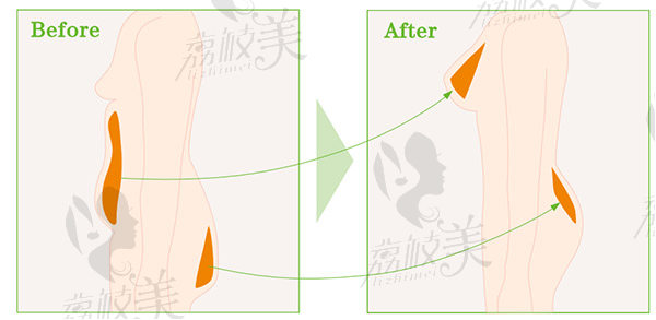 自体脂肪隆胸原理