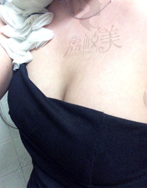 在韩国MIGO整形医院做完隆胸术后一个月