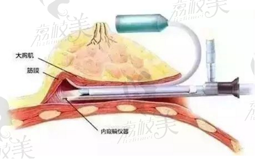 内窥镜假体隆胸