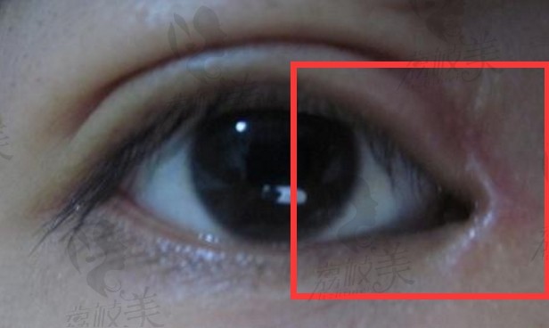 有内眦赘皮开眼角手术改善大吗/清潭成镇模做眼综合靠谱吗