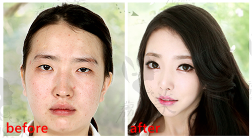 韩国灰姑娘整形医院双眼皮+鼻综合+脂肪填充or抽脂案例分享