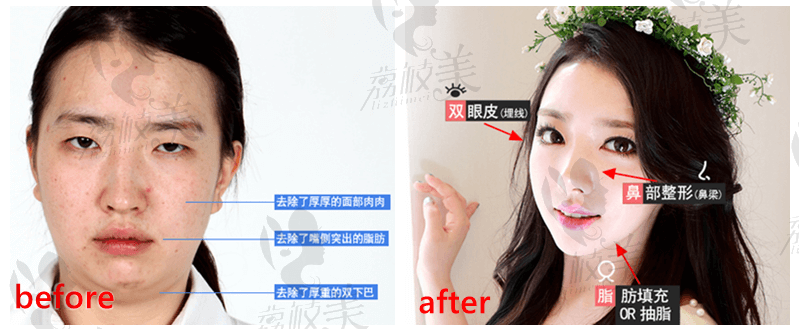韩国灰姑娘整形医院双眼皮+鼻综合+脂肪填充or抽脂案例前后对比