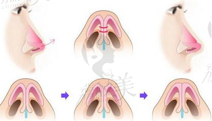 朝天鼻矫正术后不会留疤