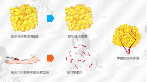 朴原辰整形自体脂肪移植