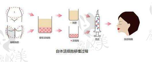 韩国碧夏医院李珉奭讲解自体脂肪面部填充，告别苦情脸