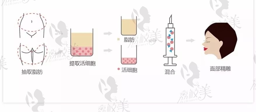 自体脂肪面部填充示意图