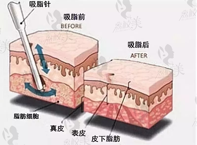 吸脂手术示意图