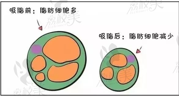 吸脂前后脂肪细胞的变化