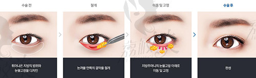韩国纯真整形外科眼底脂肪在排列手术方法