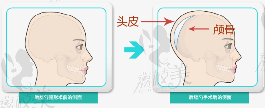 骨水泥手术，你是头次听说吗？