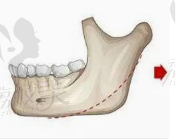 下颌角截骨.png?x-oss-process=style/lzmei