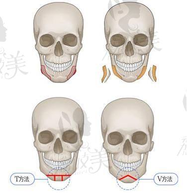 韩国轮廓医院DI和原辰都是自然风，本质区别是什么？