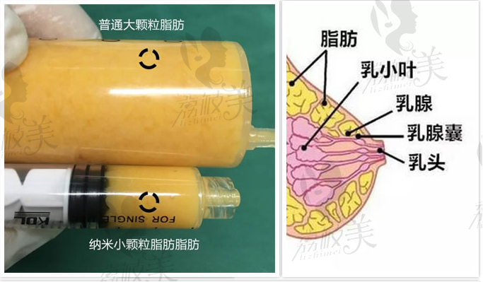 北京蜜邦超活性自体脂肪隆胸特价5800，到院送医用面膜！