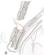 明明同眼同医生，为什么你的双眼皮做完痕迹深重，有肉条感863.png