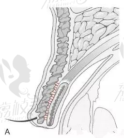 明明同眼同医生，为什么你的双眼皮做完痕迹深重，有肉条感1892.png