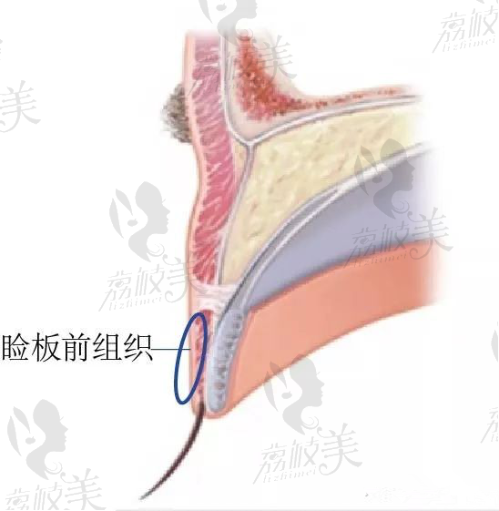 明明同眼同医生，为什么你的双眼皮做完痕迹深重，有肉条感2222.png