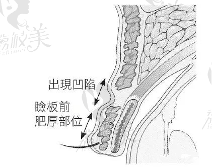 明明同眼同医生，为什么你的双眼皮做完痕迹深重，有肉条感2758.png