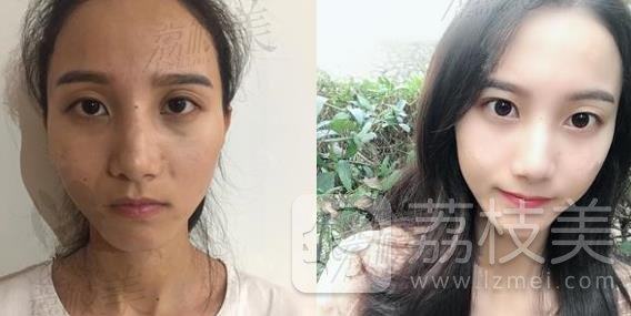 面部年轻化恢复童颜，南京艺星医疗美容，吕永全医生做的自体脂肪全脸填充