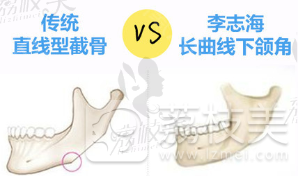 你不可能不知道上海华美整形，李志海院长长曲线下颌角截骨只有36334元！