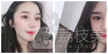 北京世熙的丁砚江，1.7W的复合分段式美鼻有什么不一样，案例对比图附上