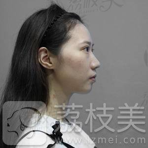 杭州甄美医疗美容医院院长王辉鼻综合案例