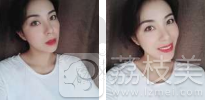 哈尔滨斯美诺范伟提升案例