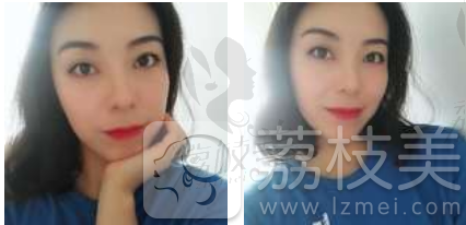 哈尔滨斯美诺范伟提升案例