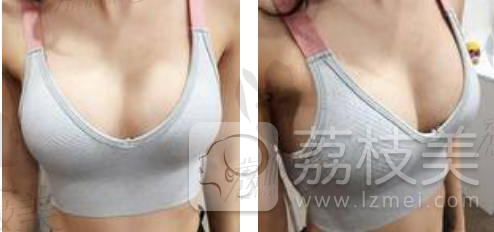 上海艺星彭才学做的傲诺拉假体隆胸只要19800元？