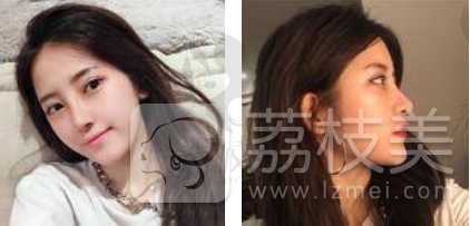 想了解广州艺美李闯的“李氏3C综合隆鼻术”吗？这里有优惠有案例哦！