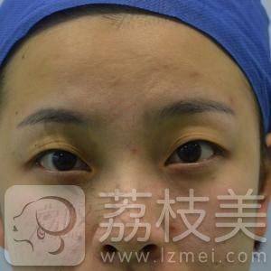 杭州东方整形王成现医生双眼皮手术案例