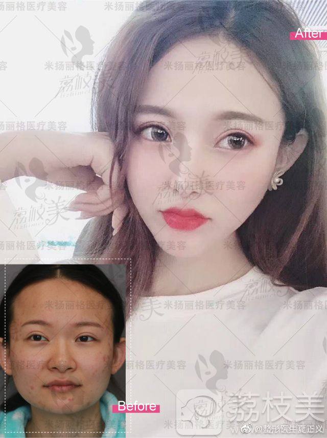 北京米杨丽格整形医院主任夏正义鼻综合案例