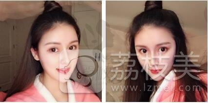想了解成都格莱丽医院怎么样？看花了3万找方忠政医生做的肋软骨鼻综合效果~