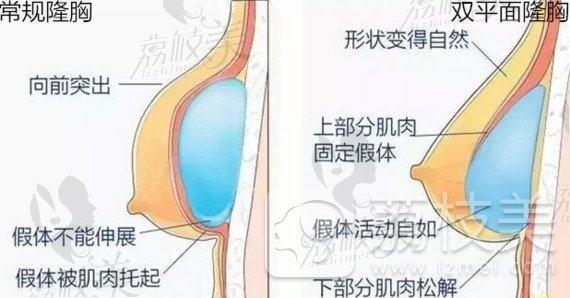 上海华美新技术，3W的假体隆胸为何能完全避免包膜挛缩？