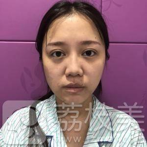 北京彤美桂行军肋骨鼻综合案例