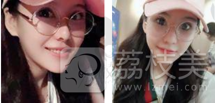 重庆瑞俪李光强：阿姨变少女，面部填充就是这么神奇