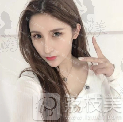 美莱鼻整形案例术后60天