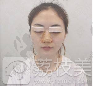 南京美贝尔鼻综合整形案例