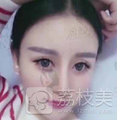 韩国灰姑娘的双眼皮和隆鼻，哪个技术好？真实案例一看便知