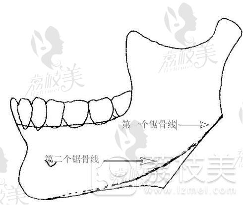韩国原辰下颌角整形手术过程，医生是怎么操作的？