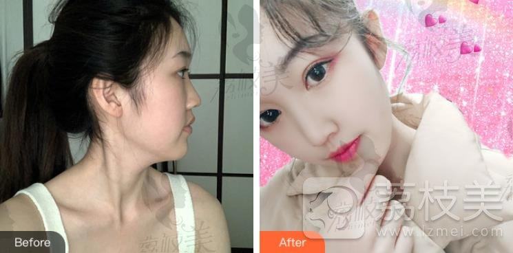 有了北京艺星薛轶群院长隆鼻技术，我也能拥有热巴同款小翘鼻了！
