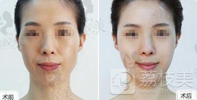 上海华美，500块怎么做到拯救脸部轮廓变形的？