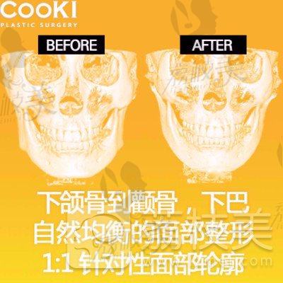 韩国cooki的轮廓下颌角术式8.6w，V-LINE瓜子脸环切3件套